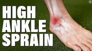 High Ankle Sprain  Syndesmosis Injury Evaluation  Education  Exercises [upl. by Thorsten387]