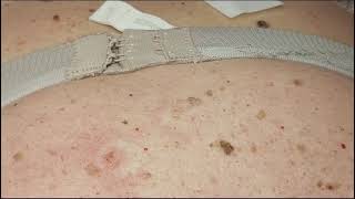 441 Seborrheic Keratosis Removal on Back Janine giving training [upl. by Imoyaba]