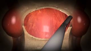 Updated Video Available Endoscopic Endonasal Pituitary and Skull Base Surgery [upl. by Ynwat806]