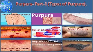 Purpura Part 1 Types of Purpura [upl. by Irat111]