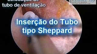 Otite SerosaColocação de quottubinhoquot Via endoscópica\Otoendoscopic ventilation tube insertion [upl. by Gerrard]