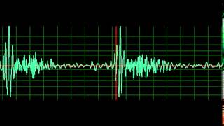 Mitral Regurgitation normal speed [upl. by Odrude]