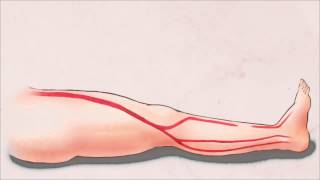 Treatment of Critical Limb Ischemia with Balloon Angioplasty and Stents [upl. by Asli]