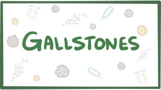 Gallstones cholelithiasis [upl. by Ennoirb271]