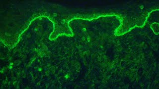 Direct immunofluorescence for autoimmune bullous diseases [upl. by Kcor210]