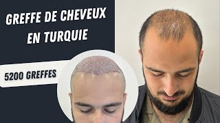 Greffe de cheveux en Turquie  Transplantation capillaire en Turquie  greffedecheveux [upl. by Drallim407]