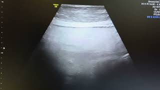 Ultrasound of panniculitis by linear and convex probe in 48 yr female with ho feverampqnorexia 45Dys [upl. by Euhc]