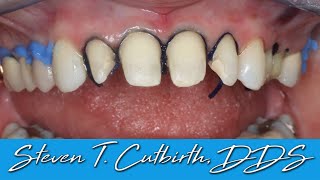 Retraction Cord Placement for Veneers amp Crowns  Dental Minute with Steven T Cutbirth DDS [upl. by Siurtemed]