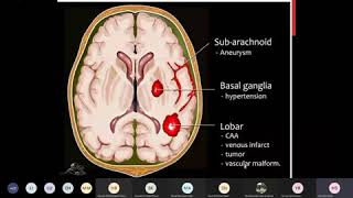 Pathology of cerebrovascular diseases  intraparenchymal heamorrhage1 [upl. by Adnarrim788]