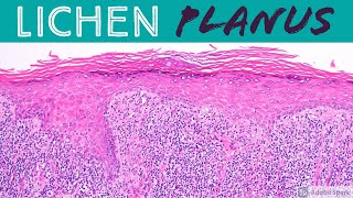 Lichen Planus amp Hypertrophic Lichen Planus Inflammatory Dermpath 101 for Dermatology amp Pathology [upl. by Duky]