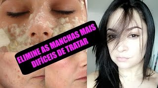 🌺COMO ELIMINAR MANCHAS DE MELASMA GRAVIDEZ ESPINHAS Receita potente [upl. by Leugimesoj]