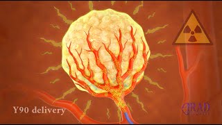 Liver Tumor Radioembolization [upl. by Sinnoda]