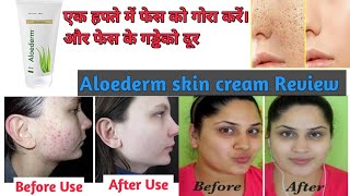 Aloederm skin cream Review and benefits in hindi  hindi health tips 4u [upl. by Mccord756]