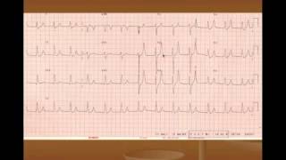 Hyperkalemia Treatment and ECG Changes [upl. by Anel613]