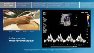 Advanced screening views of the fetal heart  Part 1  4chamber color and PW Doppler [upl. by Ailemor515]