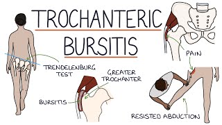 Understanding Trochanteric Bursitis [upl. by Ahsilam]