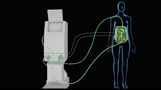 HIPEC Heated Intraperitoneal Chemotherapy [upl. by Lundin]