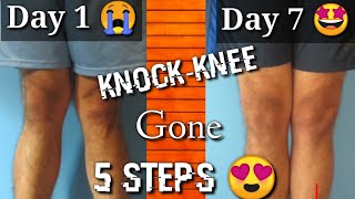 Fix Knock Knee in 7 days  knock knee problem solution [upl. by Nyrret]