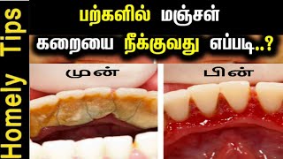 1பைசா செலவில்லாமல் பற்களில் உள்ள விடாப்பிடியான மஞ்சள் கரையை 2நாளில் நீக்கிடலாம்  Teeth Whitening [upl. by Papke]