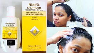 How to use Nizoral shampoo for effective results [upl. by Lia540]