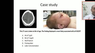 Case 134 hemorrhagi shock subgaleal hemorrhage SGH extra cranial bleeding cephalhematoma cap [upl. by Freeland749]