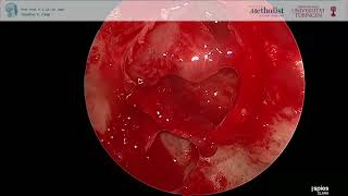 Resection of Pituitary Adenoma via transnasal transspheonidal approach Minimally Invasive Surgery [upl. by Mag]