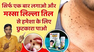 बिना दर्द गारंटी के साथ मस्सा निकालने की बेस्ट दवा  Best Mole Removal Cream  Umang Mole Removal [upl. by Heiner959]