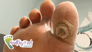 DEEP SATISFYING CALLUS TREATMENT [upl. by Fredel]