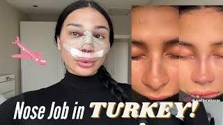 Rhinoplasty inTurkey [upl. by Celka870]