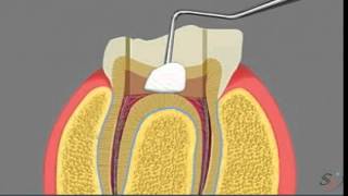 pulpotomy [upl. by Mide]