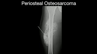 Periosteal Osteosarcoma [upl. by Rhody743]