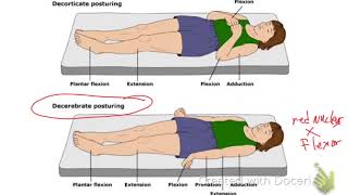 Decerebrate Vs Decorticate Posturing [upl. by Blinnie160]