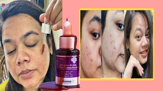 🔴The Derma Co AhaBha Peeling Solution Review after using 6 Months [upl. by Colburn]