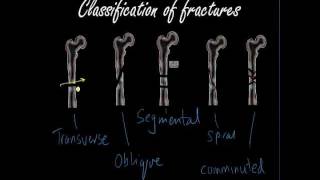 Classifying and presenting Fractures  Orthopaedics for Medical Students  Finals [upl. by Norrv]