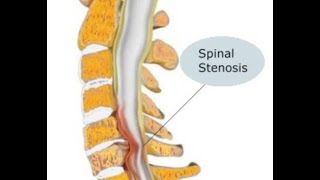 Estenosis Espinal [upl. by Anoval]