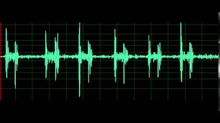 Pulmonary Associated Heart Sounds Tricuspid Regurgitation [upl. by Tena]