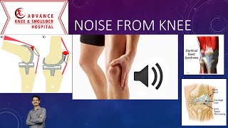 Cause of Noise From Knee [upl. by Leno]