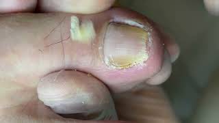 Slight fungs nail treatment [upl. by Adil]