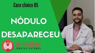 Nódulo que desapareceu  Caso clínico 05  Dr Jônatas Catunda [upl. by Egoreg692]