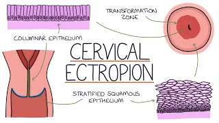 Understanding Cervical Ectropion  Cervical Erosion [upl. by Umberto]