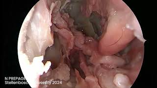 Module 7 SPA Descending palatine Maxillary artery Medial Maxillectomy and Infratemporal fossa [upl. by Daney]