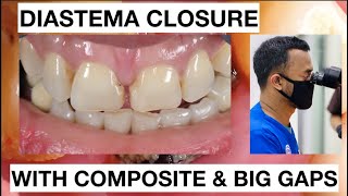 Step by Step Diastema Closure Composite with Big Gaps  General Dentist Griya RR [upl. by Aicina]