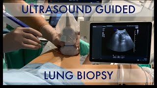 USguided lung biopsy [upl. by Asli]