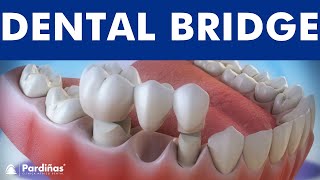 Dental bridge  Fixed dental replacement © [upl. by Rushing]