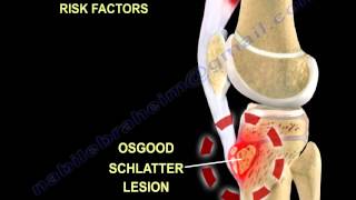 Osgood Schlatter Disease  Everything You Need To Know  Dr Nabil Ebraheim [upl. by Lashondra]