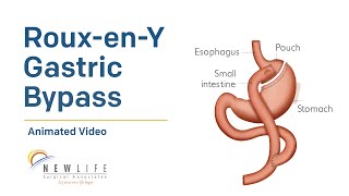 RouxenY Gastric Bypass [upl. by Akenahs]