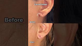 Have you ever thought about treating your earlobes [upl. by Seymour]