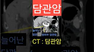 담관암 담도암 CT 진단 담관 담도 [upl. by Doak]