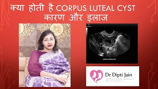 क्या होती है CORPUS LUTEAL CYST कारण और इलाज HINDI [upl. by Calore]