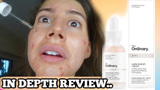 I TESTED THE ORDINARY LACTIC ACID FOR MY ACNE SCARS FOR 3 WEEKS THIS IS WHAT HAPPENED [upl. by Anilave]